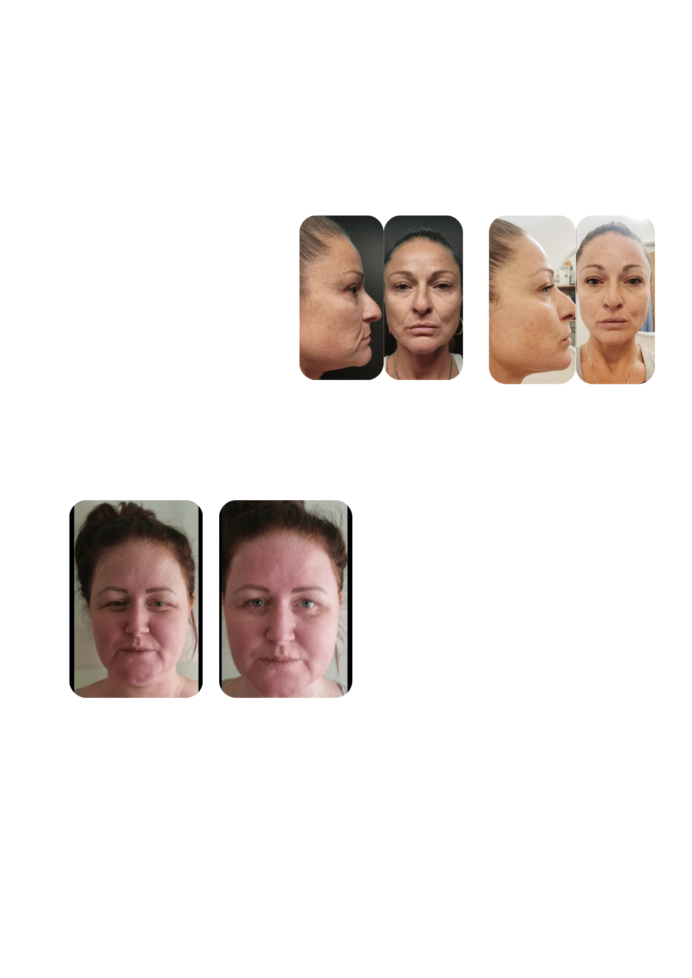 Smoother, tighter and firmer skin is achieved after performing cryofacials on women.
