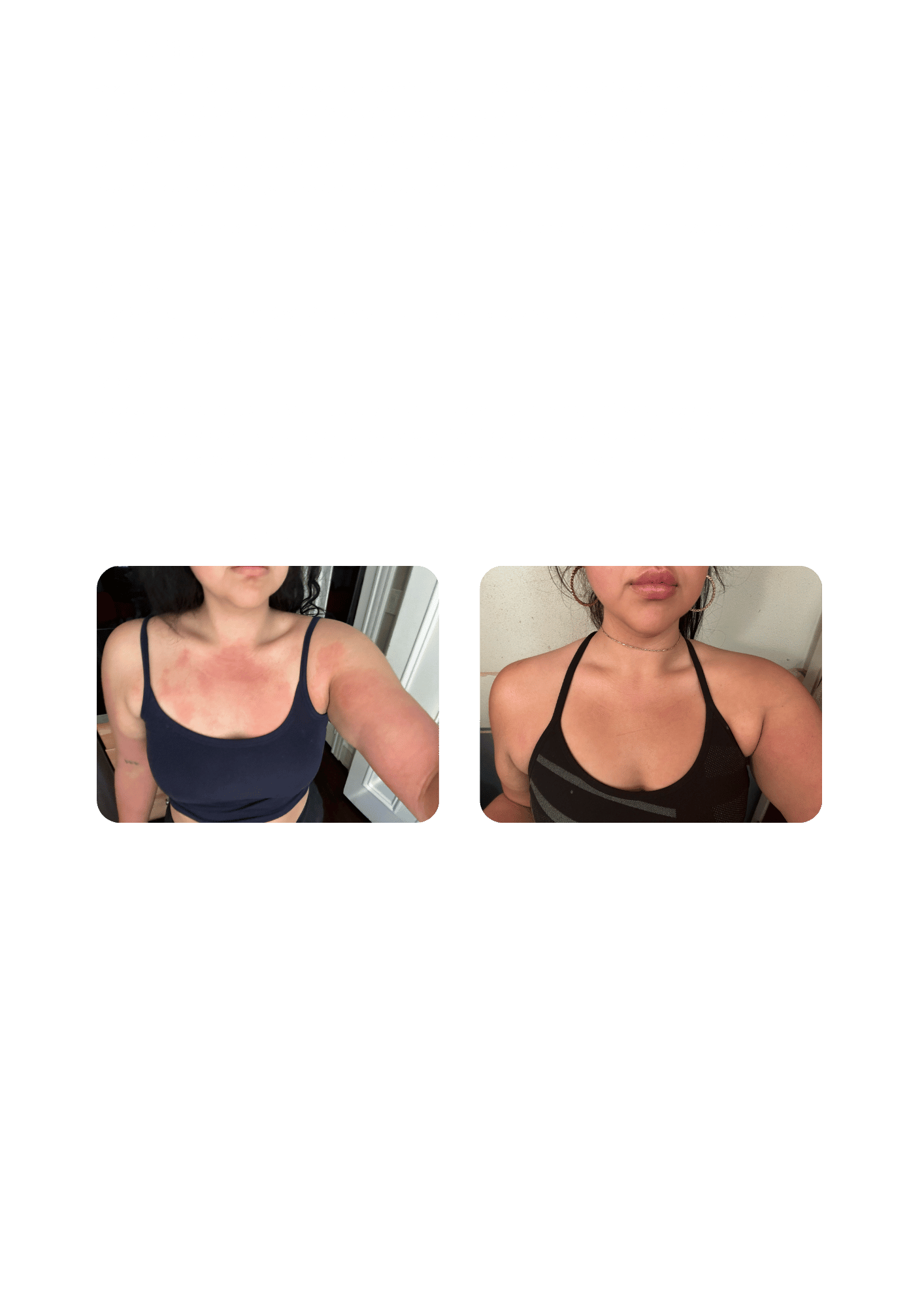 Localized cryotherapy successfully reduces the severity of eczema on a women's chest.