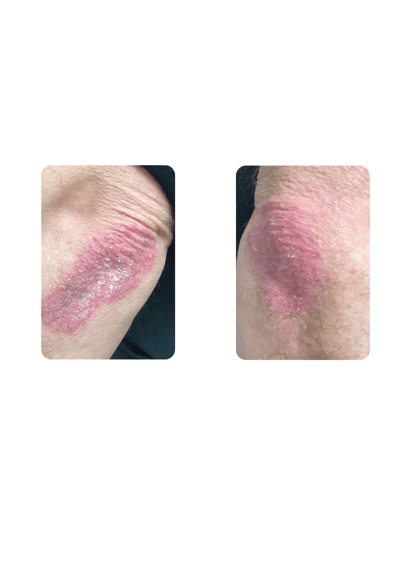 Cryotherapy reduces irritation and redness caused by elbow psoriasis.