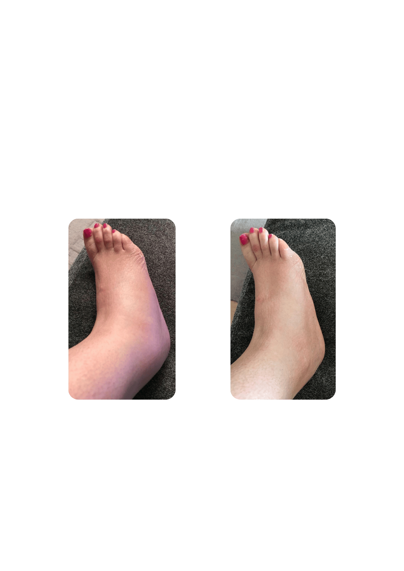 Edema in a women's ankle dramatically decreases after one localized cryotherapy treatment.