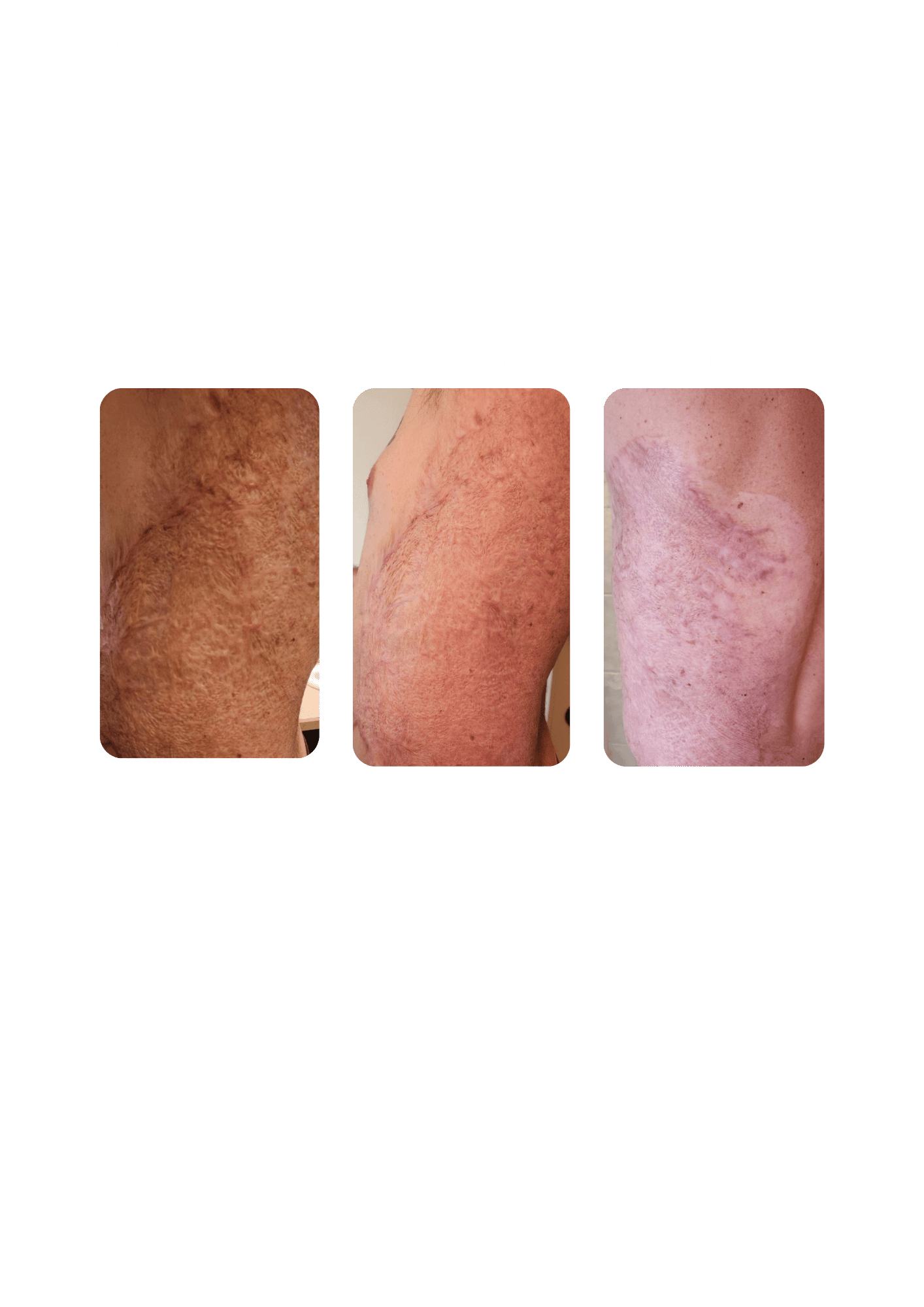 Targeted cryotherapy reduces the appearance of a third-degree burn scar.
