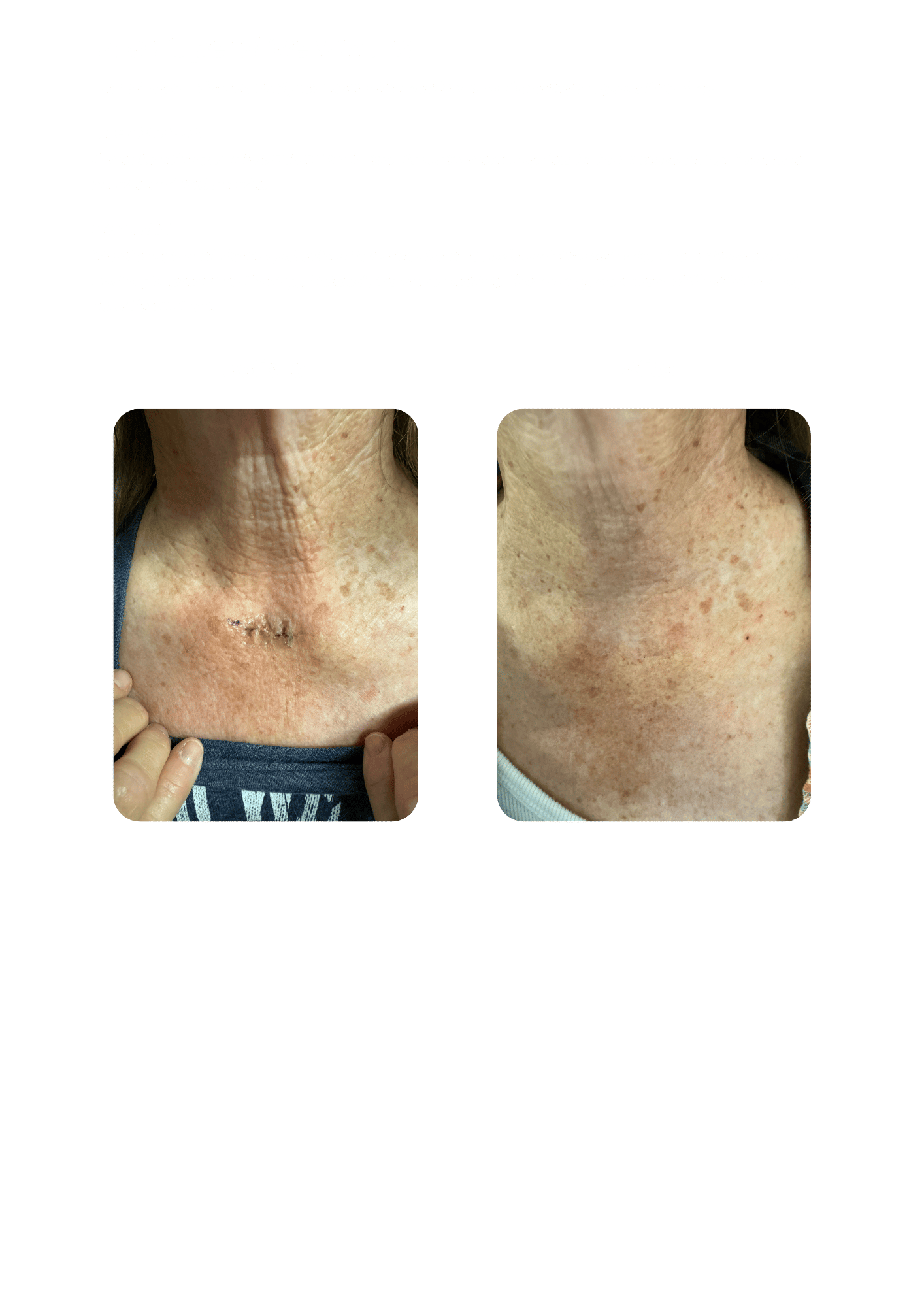 The healing of a post-operative wound is improved with targeted cryotherapy treatments.