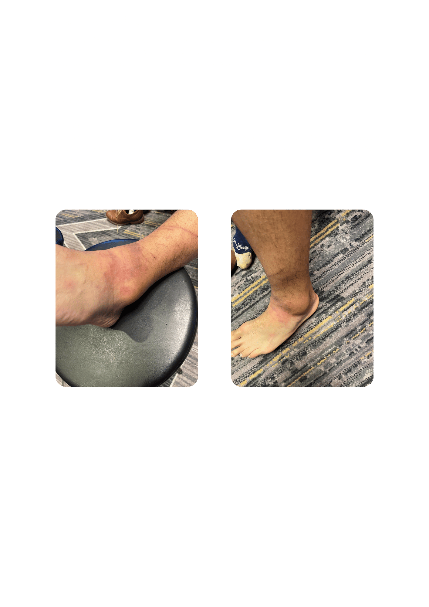 A sprained ankle recovers more quickly after a course of localized cryotherapy treatments.