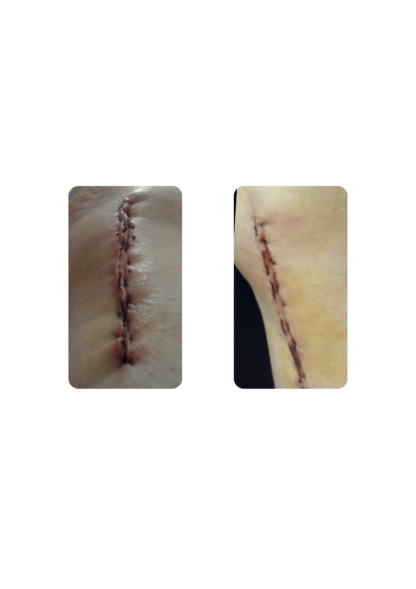 Swelling and irritation reduce around a surgical wound after localized cryotherapy is applied.