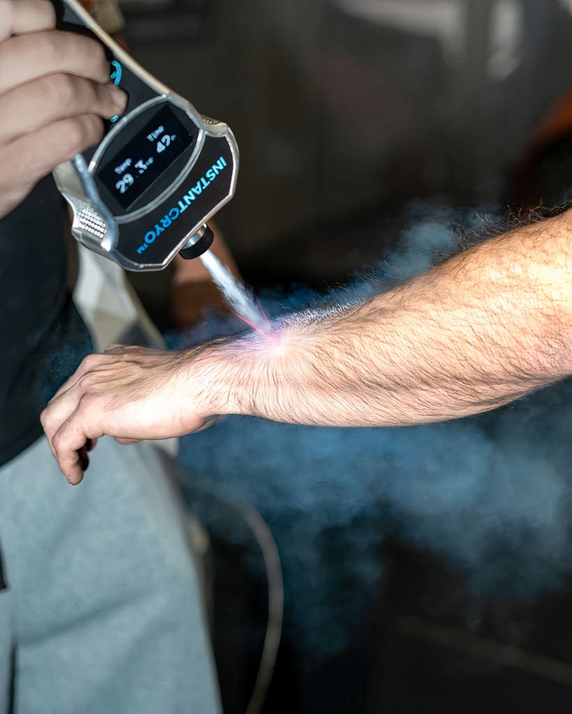 A localized cryotherapy treatment is applied to a man's arm.