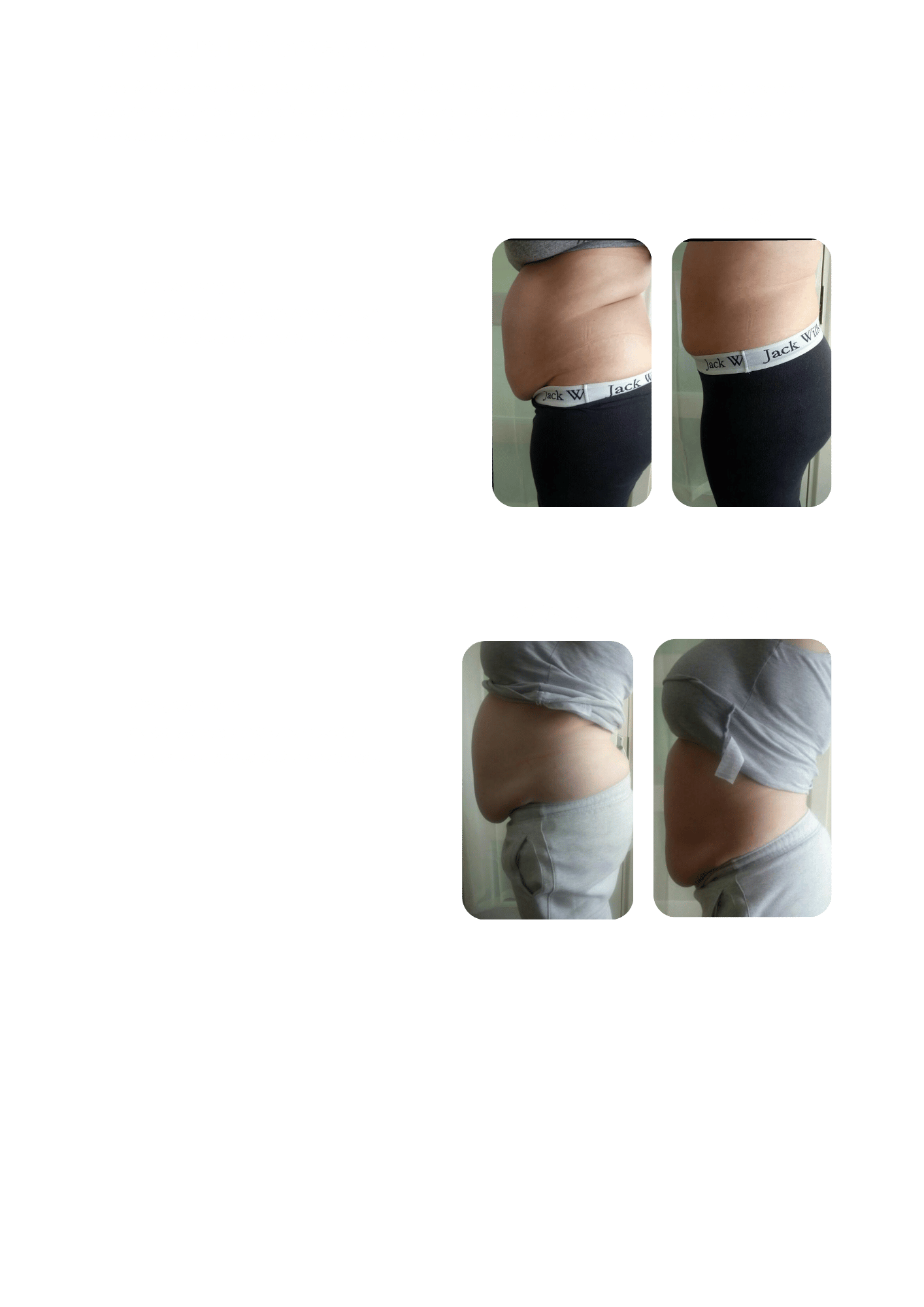 Localized cryotherapy is performed on the stomach for body sculpting, reducing water retention and puffiness.