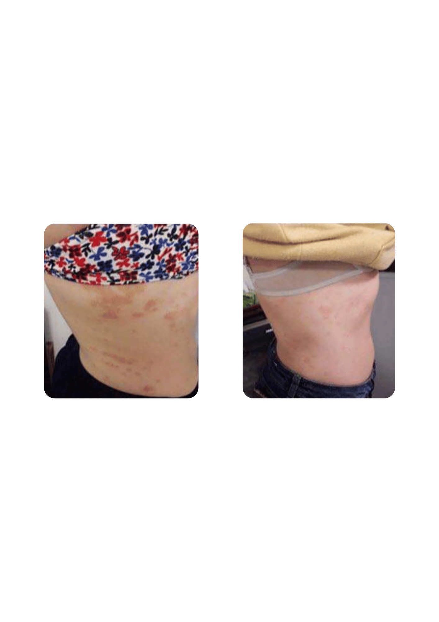 Localized cryotherapy is used to relieve symptoms of widespread psoriasis.