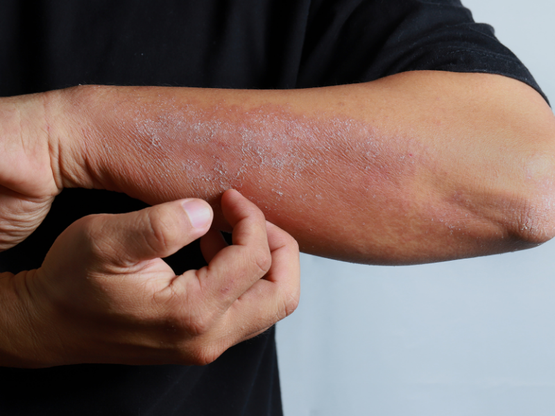 A man's arm showing irritated, itchy skin caused by a dermatological condition.