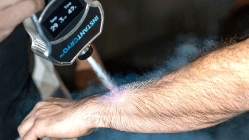 A cryotherapy treatment is performed on a man's wrist.